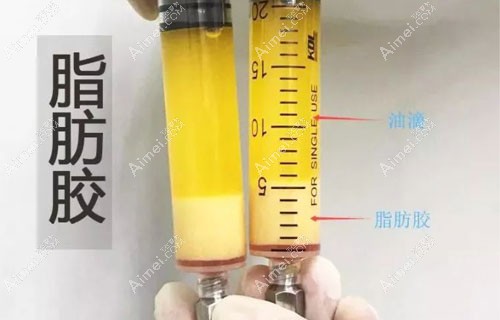 泪沟填充脂肪胶2个月像眼袋,后悔没早点了解填泪沟的弊端