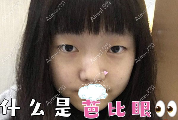 来北京画美医院找任召磊割双眼皮前.jpg 来北京画美医院找任召磊割双眼皮前.jpg