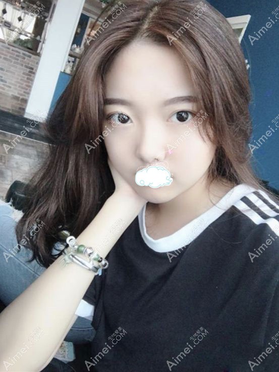 找任召磊做完7mm的全切小平行双眼皮的50天效果图.jpg 找任召磊做完7mm的全切小平行双眼皮的50天效果图.jpg