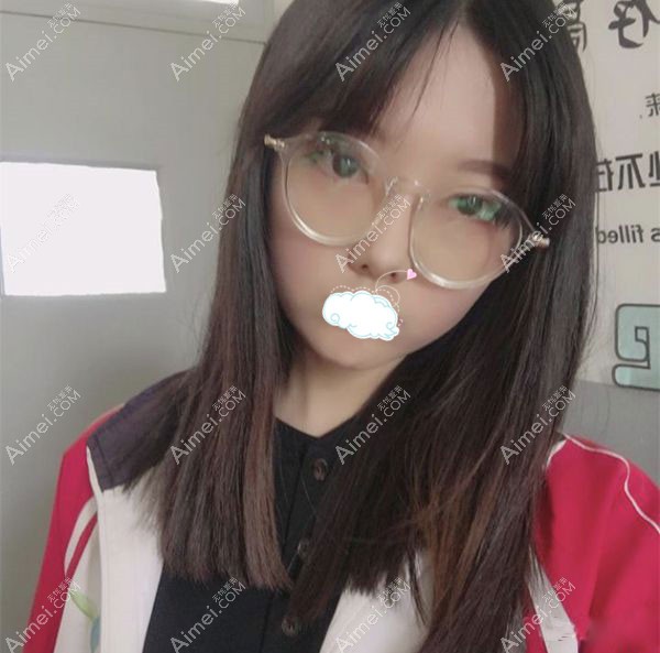 找任召磊做完7mm的全切小平行双眼皮的90天效果图.jpg 找任召磊做完7mm的全切小平行双眼皮的90天效果图.jpg