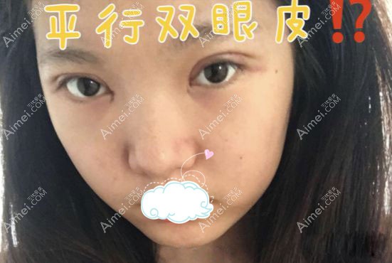 找任召磊做完7mm的全切小平行双眼皮一周效果图.jpg 找任召磊做完7mm的全切小平行双眼皮一周效果图.jpg