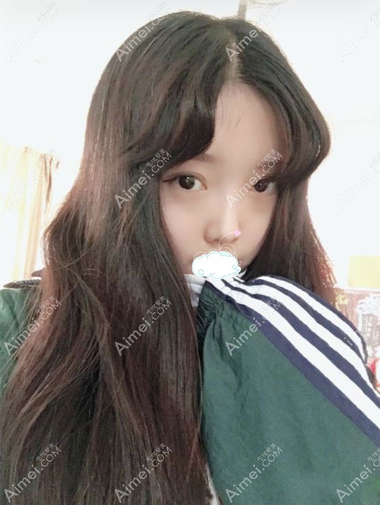 找任召磊做完7mm的全切小平行双眼皮的120天效果图.jpg 找任召磊做完7mm的全切小平行双眼皮的120天效果图.jpg