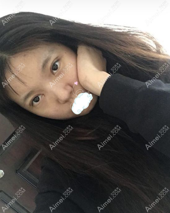 找任召磊做完7mm的全切小平行双眼皮的30天效果图.jpg 找任召磊做完7mm的全切小平行双眼皮的30天效果图.jpg