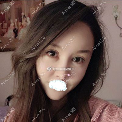 来北京丽星翼美做膨体垫眉弓术后124天效果照片.jpg 来北京丽星翼美做膨体垫眉弓术后124天效果照片.jpg