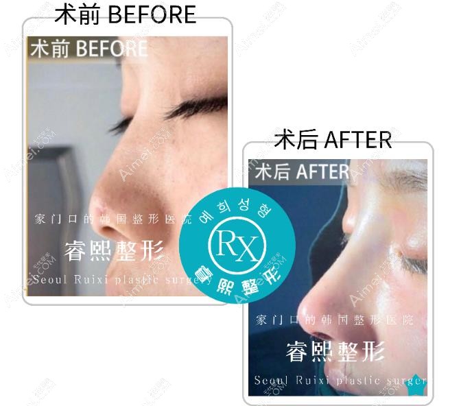 连云港睿熙肋软骨隆鼻图片 连云港睿熙肋软骨隆鼻图片