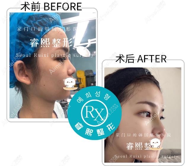 自体肋软骨鼻综合术后7天恢复对比照 自体肋软骨鼻综合术后7天恢复对比照