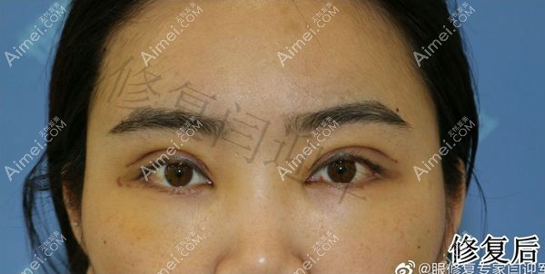 开过内眼角的双眼皮失败修复术后7天效果图.jpg 开过内眼角的双眼皮失败修复术后7天效果图.jpg