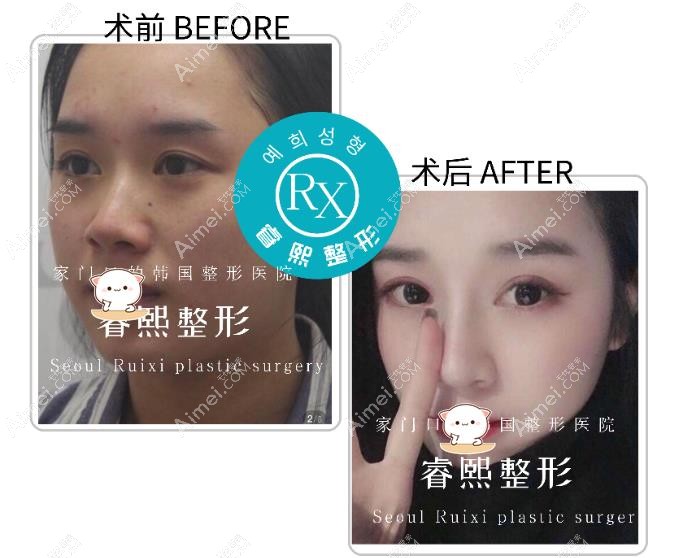 连云港睿熙自体肋软骨鼻综合效果图 连云港睿熙自体肋软骨鼻综合效果图