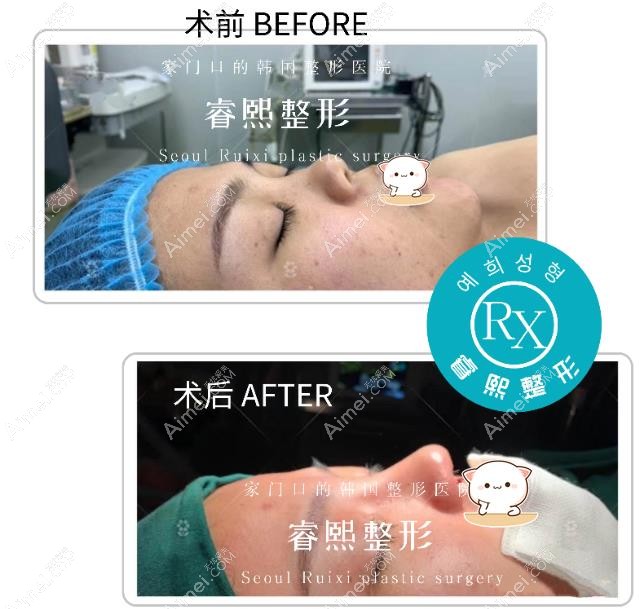 自体肋骨鼻综合术后即刻的真实图片 自体肋骨鼻综合术后即刻的真实图片