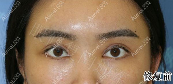 开过内眼角的双眼皮失败修复术前.jpg 开过内眼角的双眼皮失败修复术前.jpg