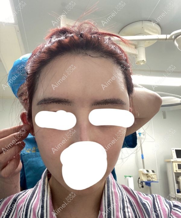 段卿然植眉前画线效果图.jpg 段卿然植眉前画线效果图.jpg