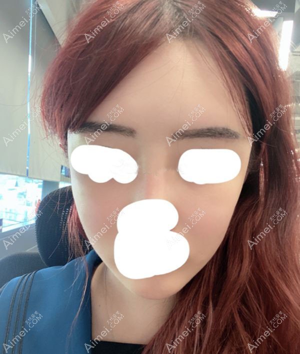 做完植眉手术一周的效果图片.jpg 做完植眉手术一周的效果图片.jpg