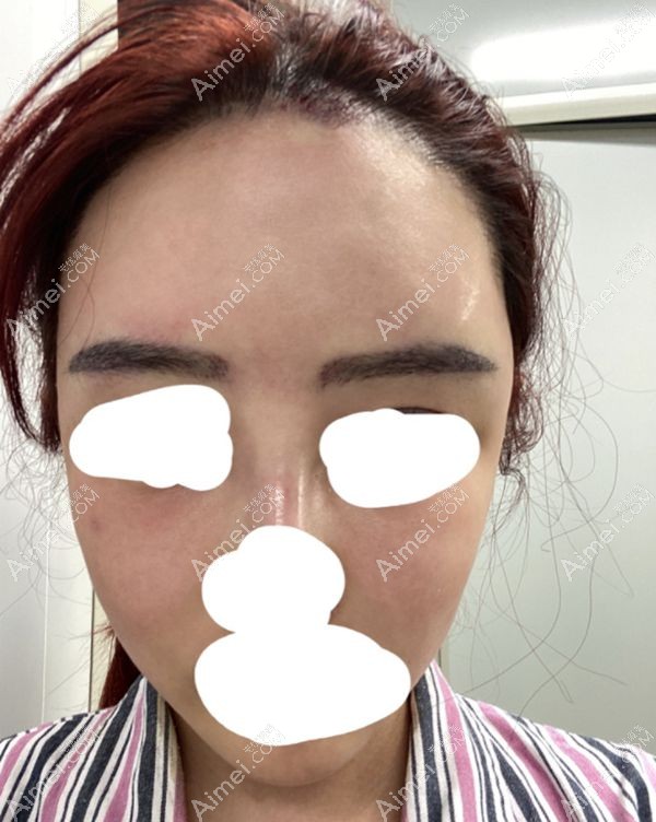 在北京十优找段卿然植眉后的即刻效果图.jpg 在北京十优找段卿然植眉后的即刻效果图.jpg