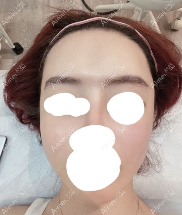 找段卿然做完植眉两个月的效果照片.jpg 找段卿然做完植眉两个月的效果照片.jpg