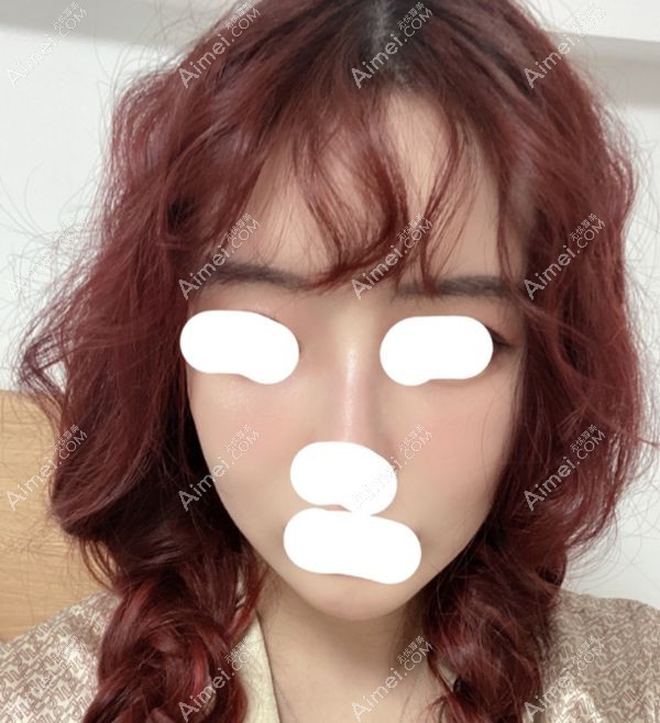 植眉手术过了一个月没修剪眉毛的样子.jpg 植眉手术过了一个月没修剪眉毛的样子.jpg