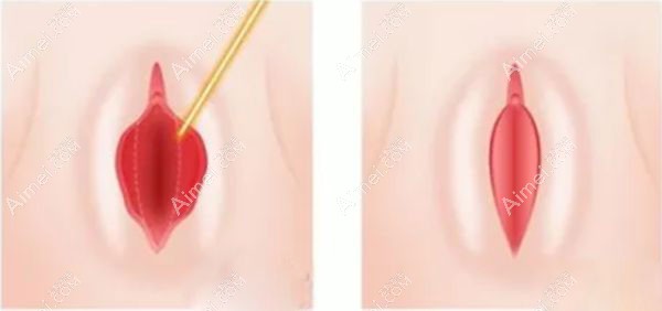 在北京画美做完小阴唇缩小1个月后的对比示意图.jpg 在北京画美做完小阴唇缩小1个月后的对比示意图.jpg