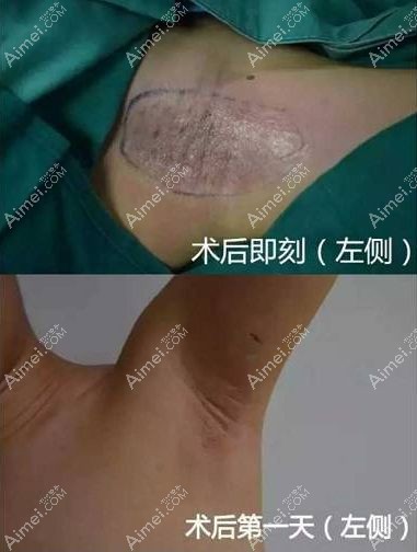 黄金微针治疗腋臭的术后即刻照片和第一天照片.jpg 黄金微针治疗腋臭的术后即刻照片和第一天照片.jpg