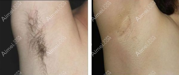 分享在包头叶子做完射频激光去腋臭的7天对比图.jpg 分享在包头叶子做完射频激光去腋臭的7天对比图.jpg