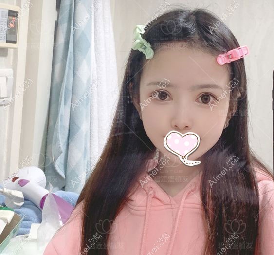 不剃发种植发际线1000单位术后3个月照片.jpg 不剃发种植发际线1000单位术后3个月照片.jpg