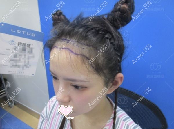 不剃发种植发际线1000单位术前照片.jpg 不剃发种植发际线1000单位术前照片.jpg