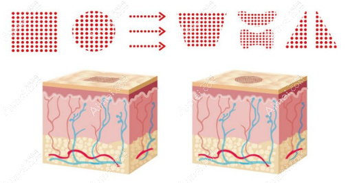 点阵激光祛痘印痘坑原理 点阵激光祛痘印痘坑原理