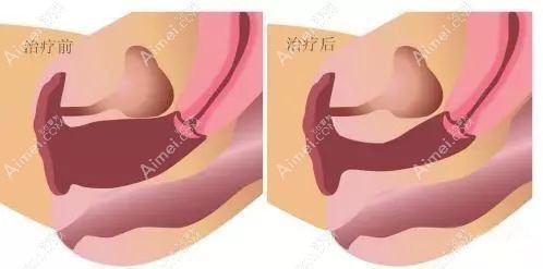 埋线缩阴手术前后对比图.jpg 埋线缩阴手术前后对比图.jpg