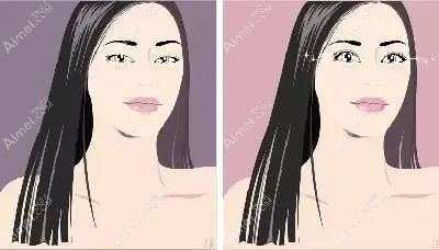 20221114757486.jpg 双眼皮修复.jpg