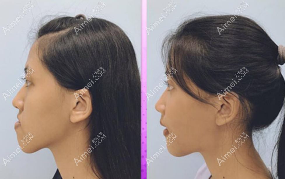 泰国磨骨手术前后对比图 泰国磨骨手术前后对比图