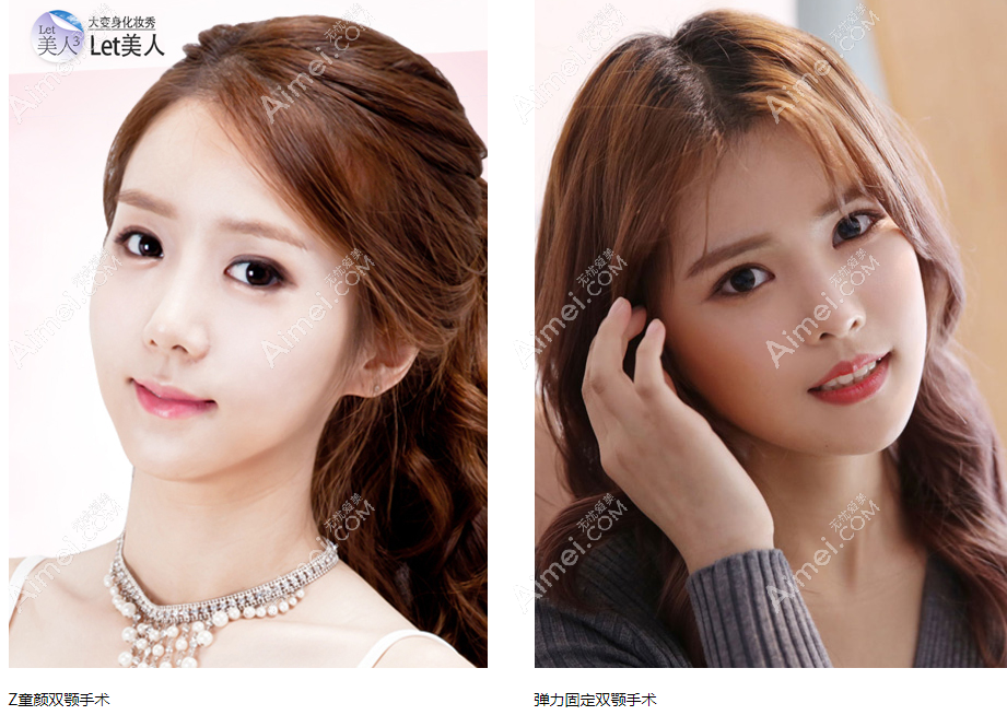 韩国菲斯莱茵faceline双鄂手术实例 韩国菲斯莱茵faceline双鄂手术实例