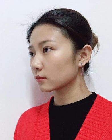 合肥华美整形美容医院隆鼻果记录分享,介绍实图查看