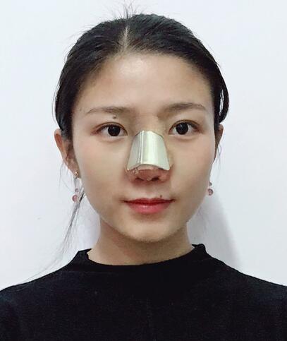 合肥华美整形美容医院隆鼻果记录分享,介绍实图查看