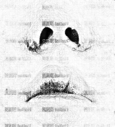 亲身经历!鼻翼缩小术后10天的终于来了