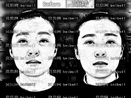 广州武警整形医院光子嫩肤体验:锁龄果太赞!