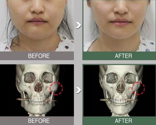 为什么有人做完颧骨手术后悔死了?真相大公开