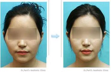 为什么有人做完颧骨手术后悔死了?真相大公开