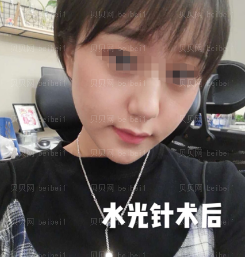 西京医院整形科樊星水光美肤介绍片较新分享_经过这次皮肤治疗,我也有了更大的信心了哦。