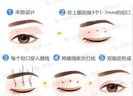 重庆军科整形曹吕梅医生双眼皮 重庆军科整形曹吕梅医生双眼皮