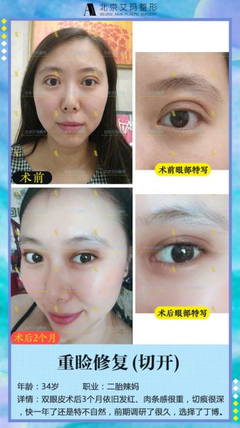 北京艾玛李方奇双眼皮修复技术怎么样?有双眼皮修复案例吗?