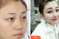 上海馨美整形美容门诊部王晓阳整形价格表附双眼皮手术案例果
