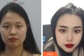北京柏丽医疗美容门诊部于波整形价格表附双眼皮手术案例果