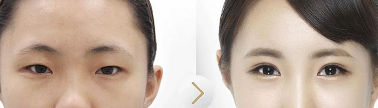 双眼皮对比图.jpg