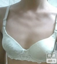 自体脂肪隆胸