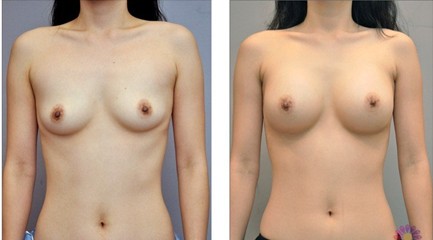 自体脂肪隆胸