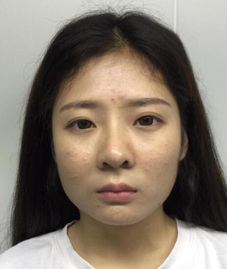 成都美容整形医院下颌角整形案例