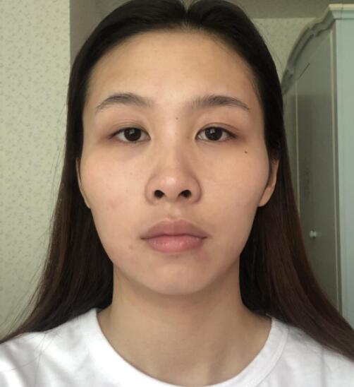 四川友谊医院颧骨颧弓整形术案例