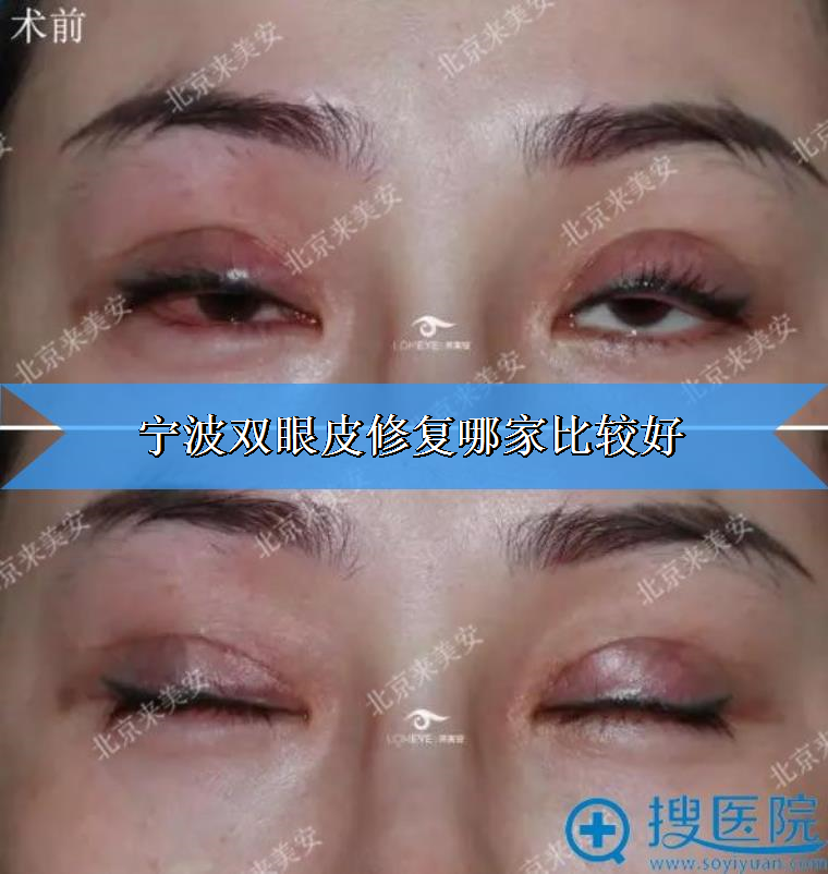 宁波双眼皮修复哪家比较好?