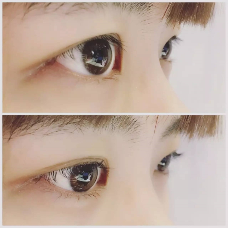 7天的双眼皮,又要几天能恢复到自然?