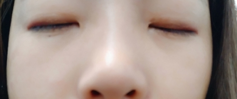 眼部吸脂的费用大概是多少?