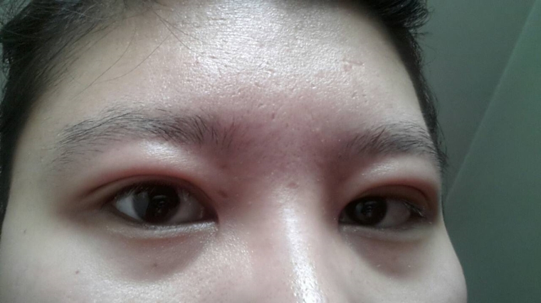 眼部吸脂的费用大概是多少?