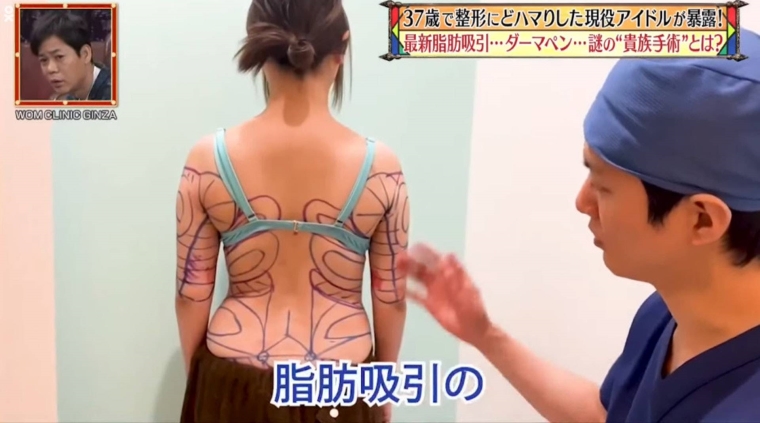 背部吸脂的价格是多少?